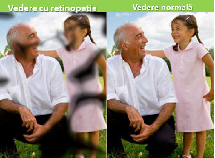 retinopatie.png